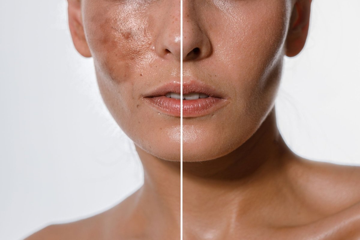 What can I do about Melasma?