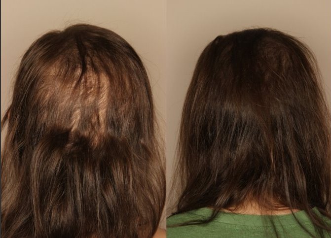 Alopecia Universalis Reversed with in-office laser treatments