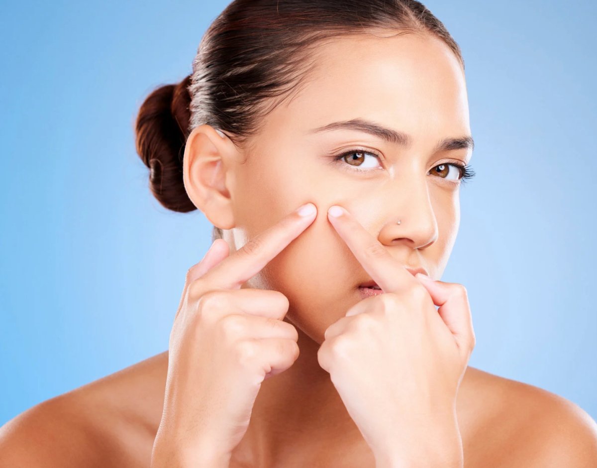 Acne Breakouts: The Ultimate Skin Battle