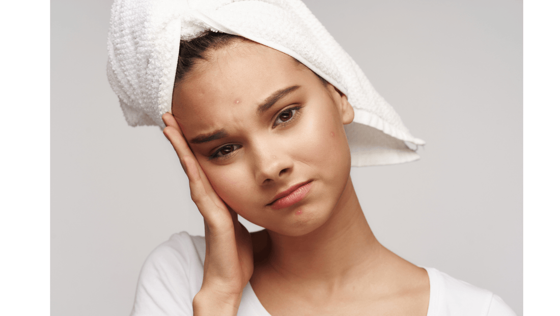 Acne Update: Facts You May Not Know