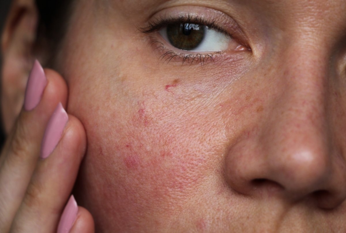 Decoding Sensitive Skin: Barrier Repair 101