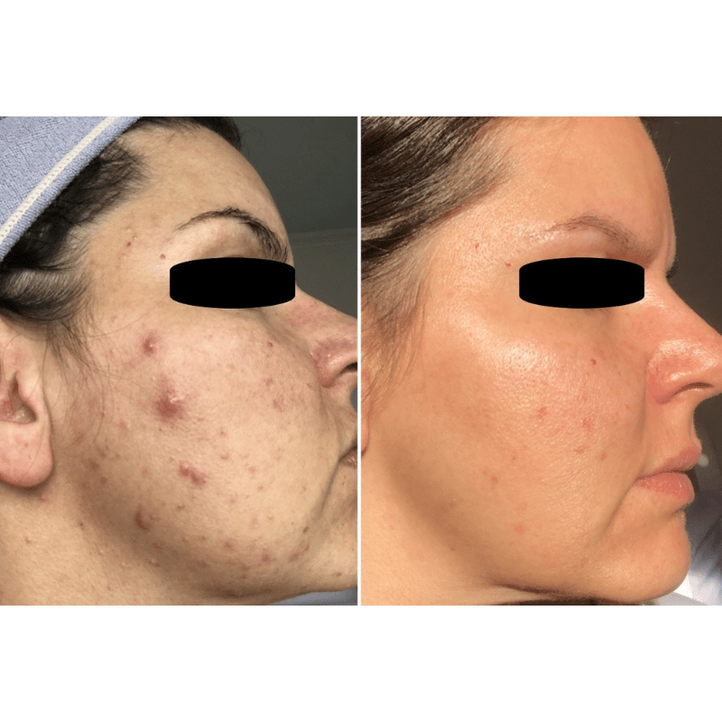 The Science: New Data on Preventing Acne