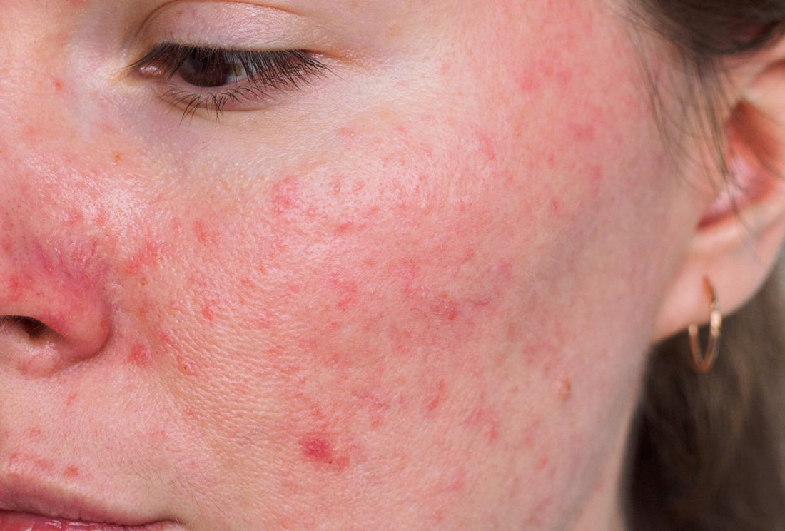 [Q&A Session] Help! Is it Rosacea or Change of Seasons?