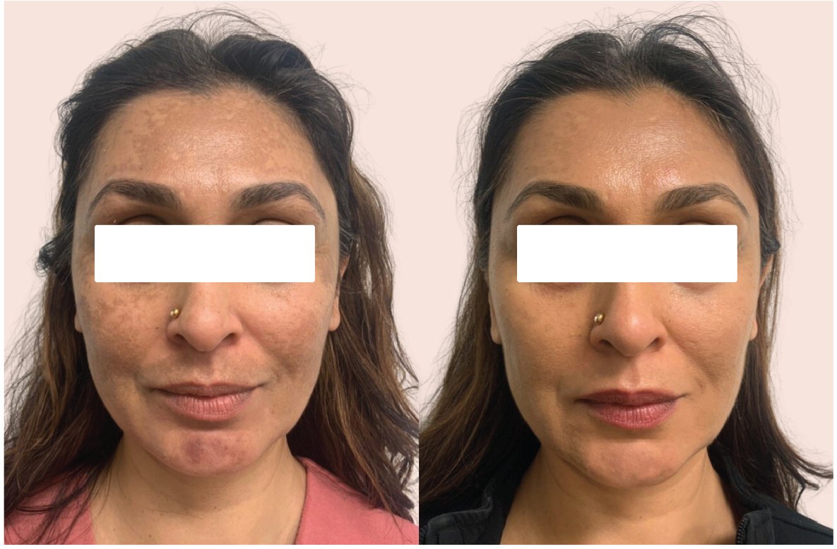 Melasma Demystified